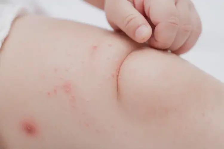 寶寶大腿上偶爾長濕疹可以徹底自愈嗎(圖4)