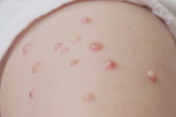 嬰幼兒大腿上偶爾起濕疹不管它會自己好嗎(圖4)