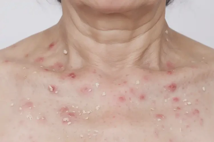 女人脖子长湿疹能不能彻底自愈(图3)