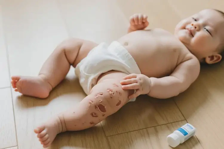 嬰兒四肢有濕疹不管它會(huì)自己好嗎(圖3)