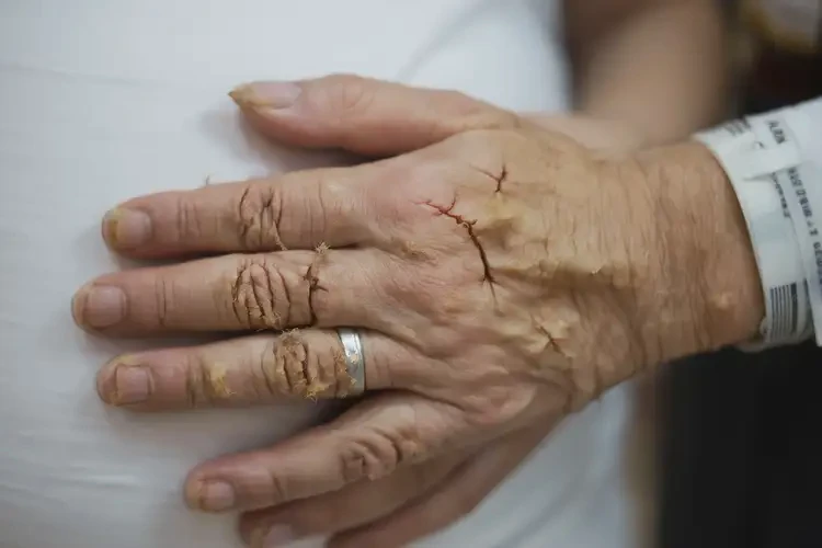 产妇手上容易起湿疹不管它会自己自愈吗(图4)