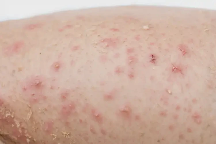 青年人大腿有濕疹不管它會自己好嗎(圖2)