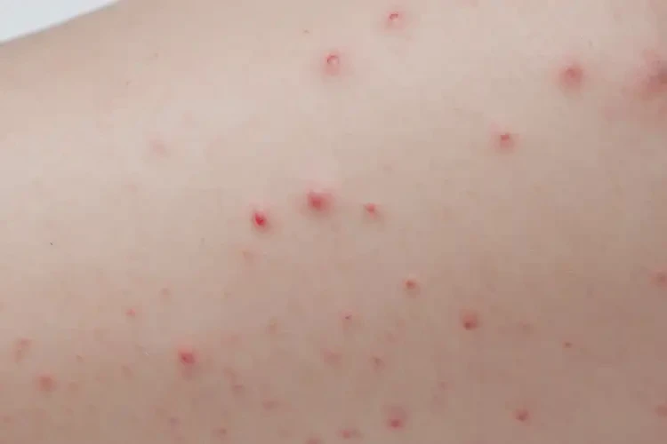 小孩小腿偶尔起湿疹不管它会自己痊愈吗(图4)