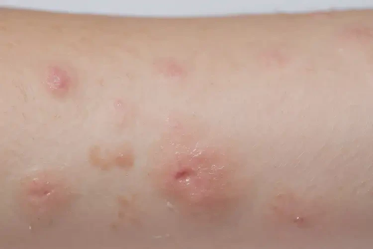 孩子手臂上偶爾長濕疹不管它會(huì)自己痊愈嗎(圖4)