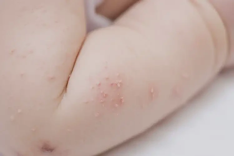 幼兒屁股上經(jīng)常起濕疹不管它會自己自愈嗎(圖4)