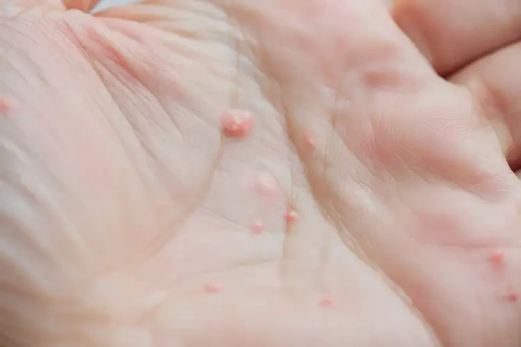 男生手上偶爾長(zhǎng)濕疹不管它會(huì)自己自愈嗎(圖4)