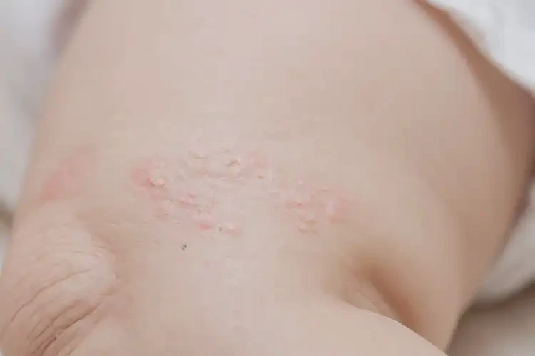 寶寶大腿上容易起濕疹能靠自己自愈嗎(圖4)