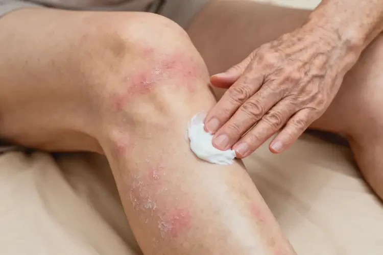 老人大腿上出現(xiàn)濕疹不管它會自己痊愈嗎(圖2)