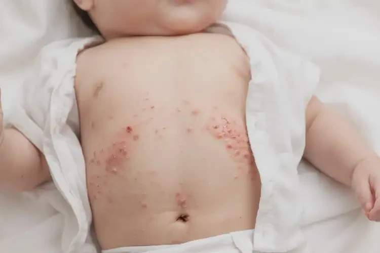 宝宝肚子上长湿疹可不可以彻底自愈(图4)