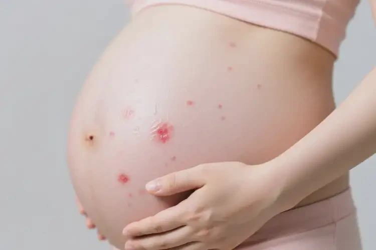 產(chǎn)婦肚子上偶爾長濕疹可以徹底自愈嗎(圖3)
