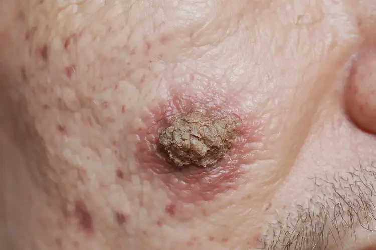 男生身上起濕疹不管它會自己痊愈嗎(圖2)