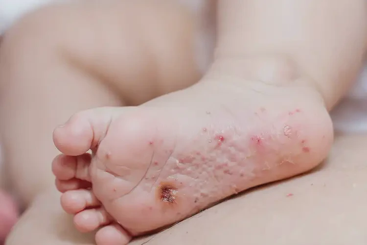 幼儿脚上容易起湿疹不管它会自己自愈吗(图4)