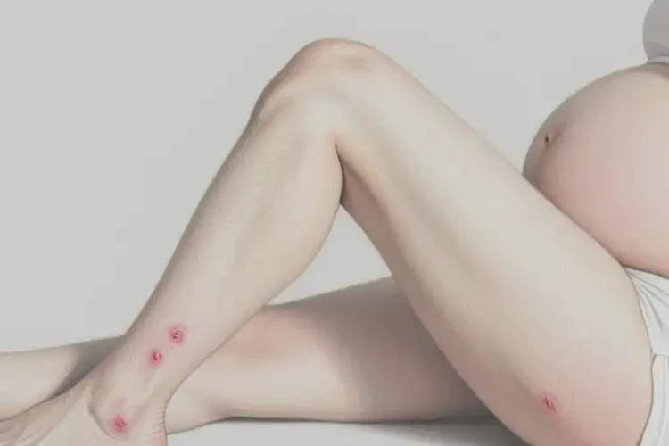 孕婦四肢出濕疹不管它會自己痊愈嗎(圖3)