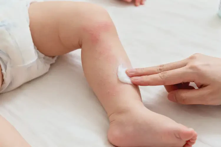 嬰兒小腿有濕疹不管它會(huì)自己痊愈嗎(圖4)