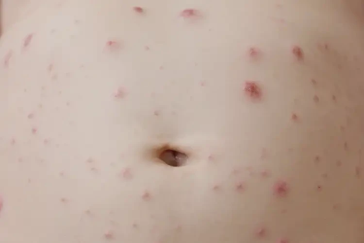 嬰兒肚子上有濕疹不管它會自己痊愈嗎(圖4)