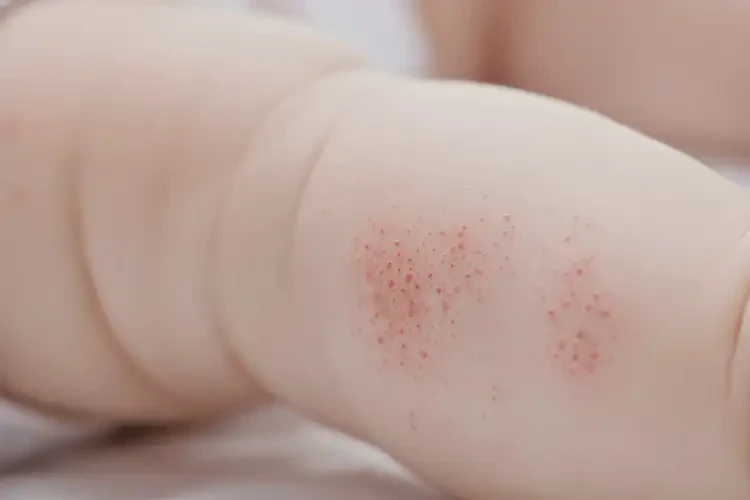 嬰幼兒屁股容易起濕疹不管它會自己痊愈嗎(圖3)