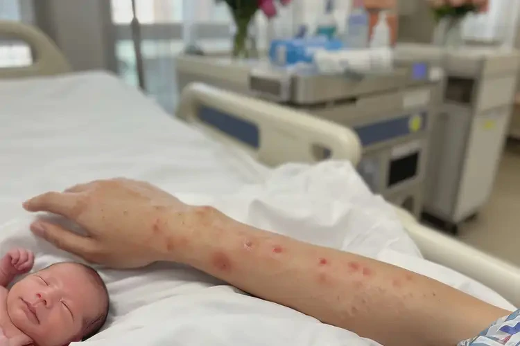 產(chǎn)婦手臂上出濕疹可不可以徹底自愈(圖3)