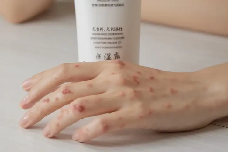 哺乳期媽媽手上偶爾長(zhǎng)濕疹能不能徹底自愈(圖3)