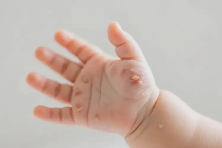 嬰幼兒手上偶爾長(zhǎng)濕疹能靠自己自愈嗎(圖4)