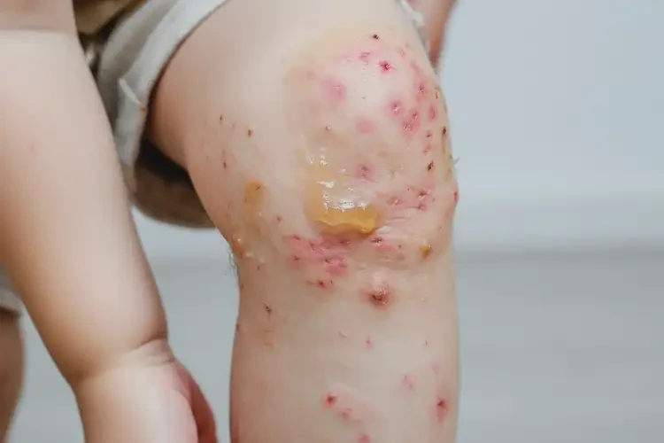 少兒脖子上偶爾起濕疹不管它會自己痊愈嗎(圖2)