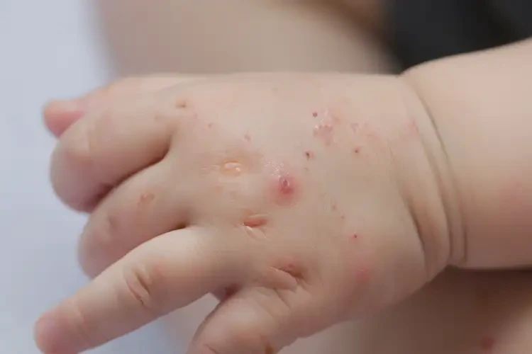 幼儿手上长湿疹能够彻底治愈吗(图4)