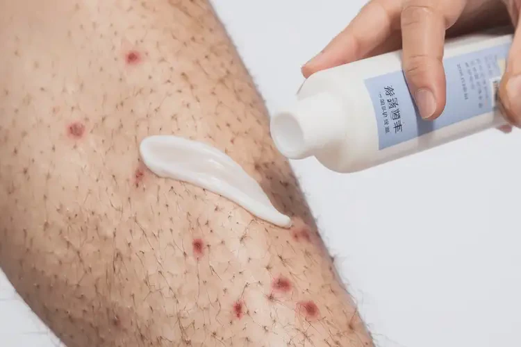 男性小腿上容易起濕疹不管它會自己好嗎(圖3)