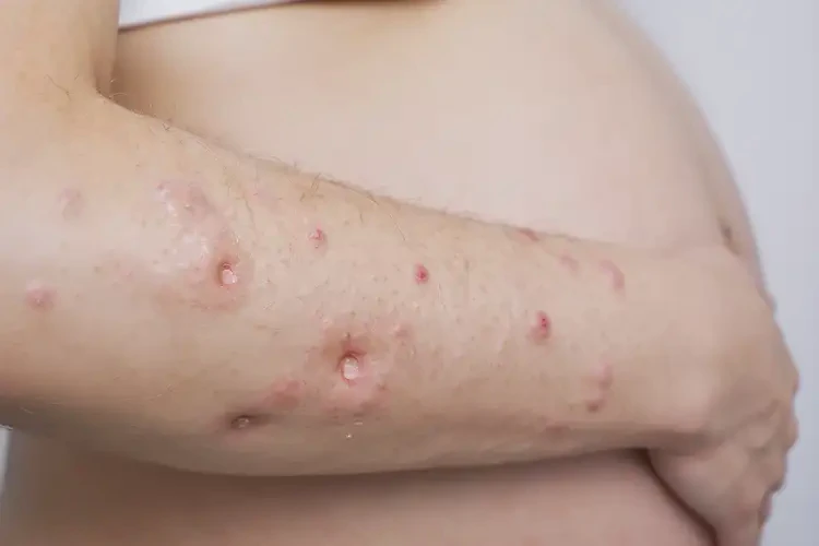 孕妇手臂上偶尔起湿疹不管它会自己好吗(图3)