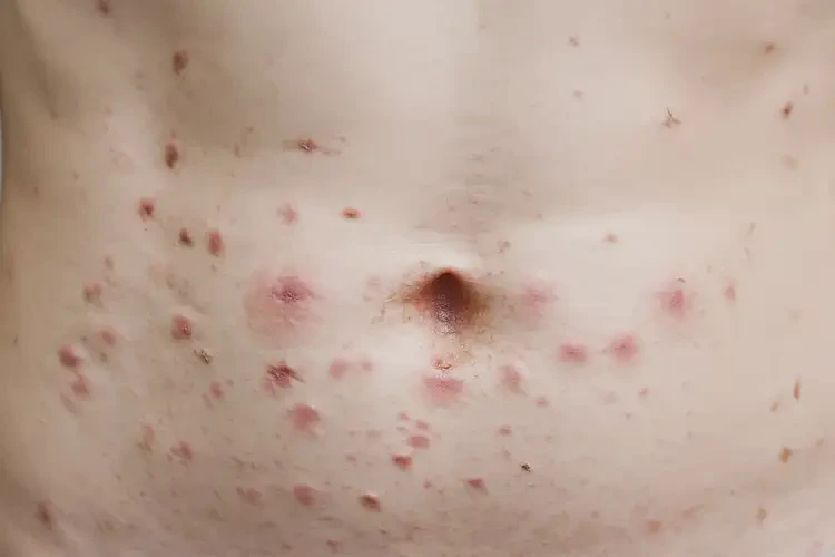 大學(xué)生肚子起濕疹可以徹底自愈嗎(圖4)