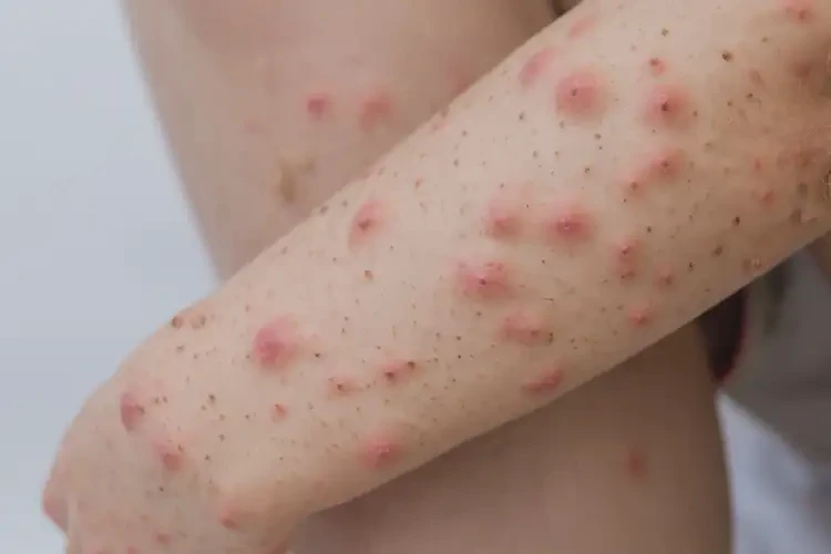 中學生四肢出現(xiàn)濕疹不管它會自己自愈嗎(圖4)