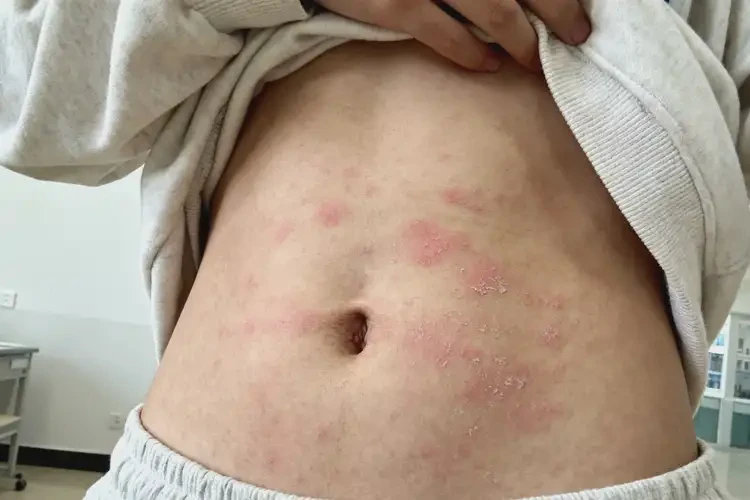 大學(xué)生肚子上起濕疹可以徹底自愈嗎(圖2)