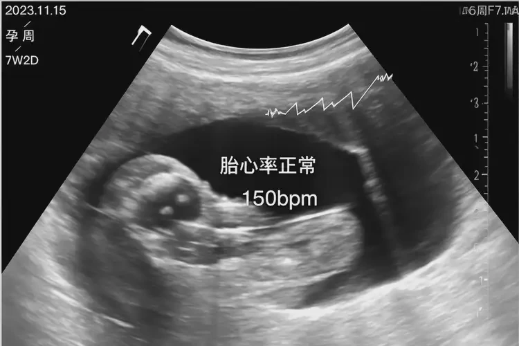 孕7周胎心率178還能保住嗎(圖4)