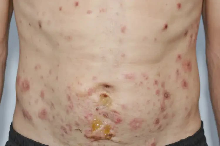 男人肚子上偶爾起濕疹不管它會自己好嗎(圖3)