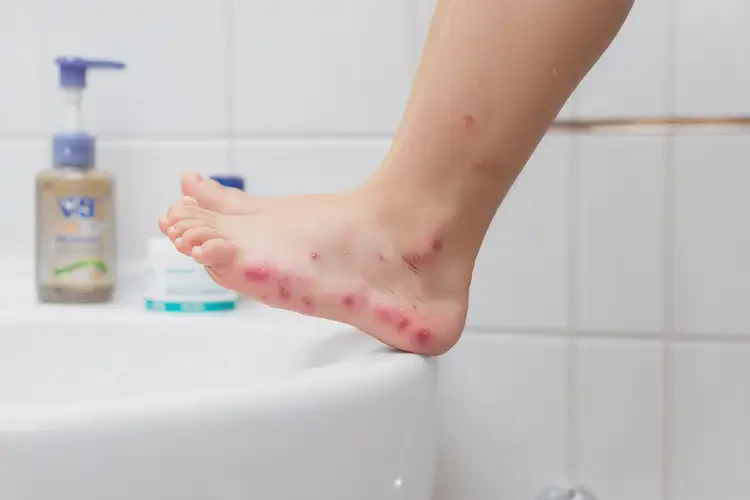 孩子腳上容易起濕疹能夠徹底治愈嗎(圖4)