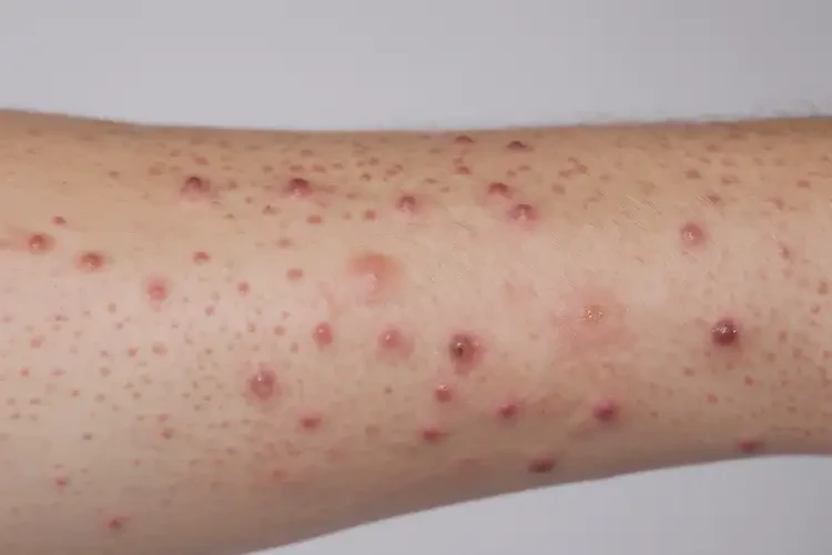 女性身上出濕疹可不可以徹底自愈(圖4)