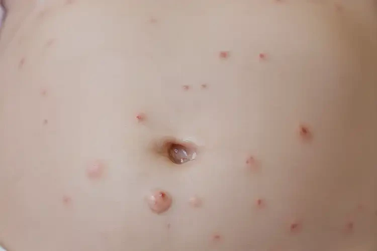 嬰幼兒肚子容易起濕疹能徹底自愈嗎(圖4)