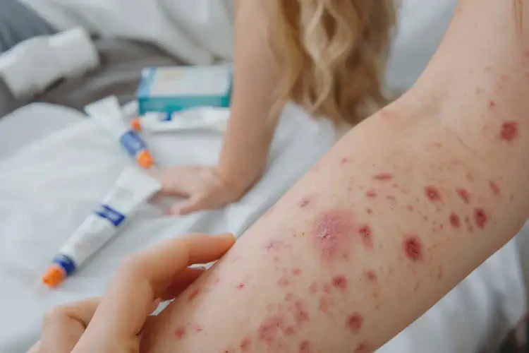 產(chǎn)婦手臂上容易長(zhǎng)濕疹可不可以徹底自愈(圖4)