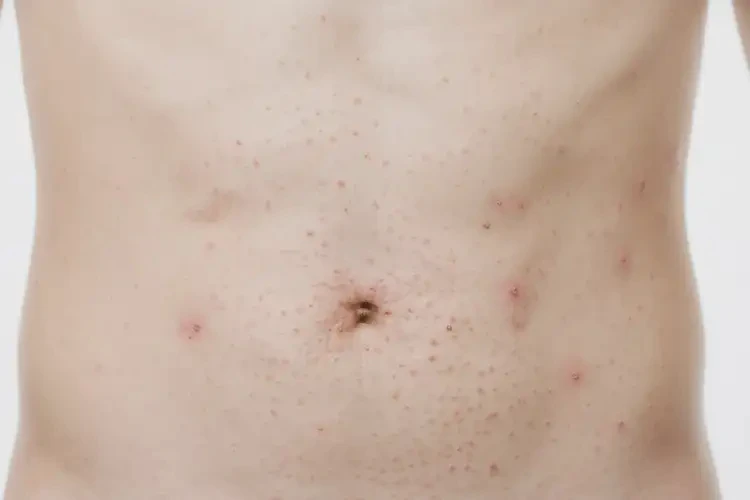 男人肚子上偶爾長(zhǎng)濕疹能徹底自愈嗎(圖1)