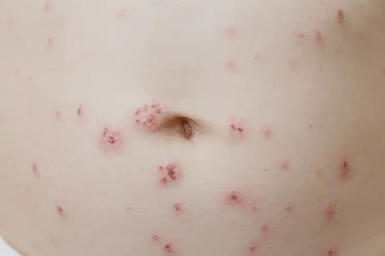 幼兒肚子上容易起濕疹不管它會(huì)自己自愈嗎(圖4)