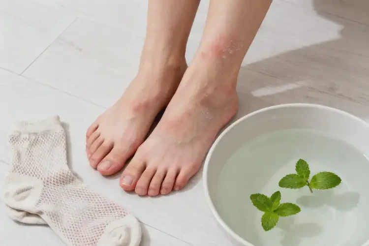 女性腳上偶爾起濕疹可以徹底自愈嗎(圖1)