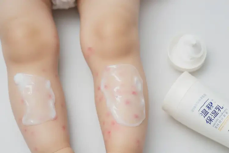 孩子大腿上偶爾起濕疹能靠自己自愈嗎(圖3)