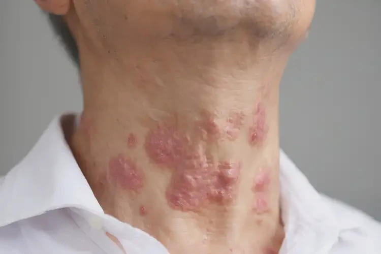 男性脖子上有濕疹不管它會自己好嗎(圖4)