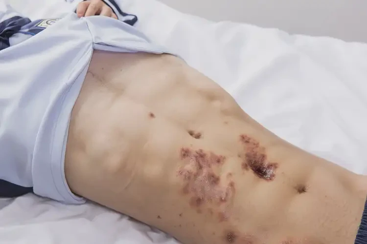 中學生肚子長濕疹可不可以徹底自愈(圖2)