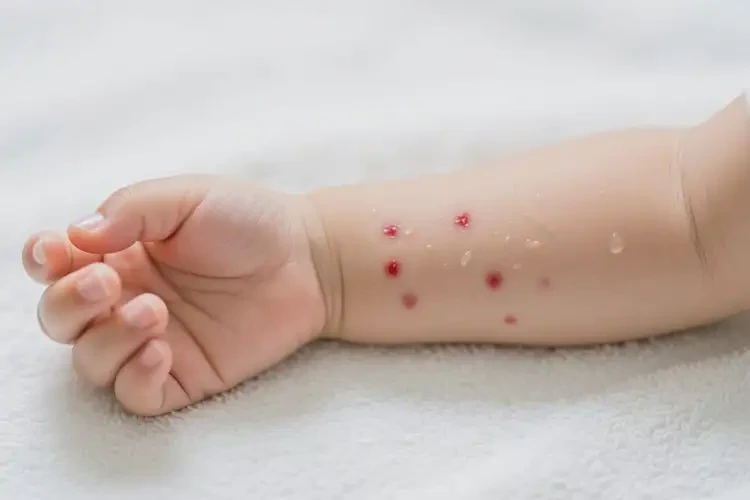 小儿手臂上出湿疹能靠自己自愈吗(图2)