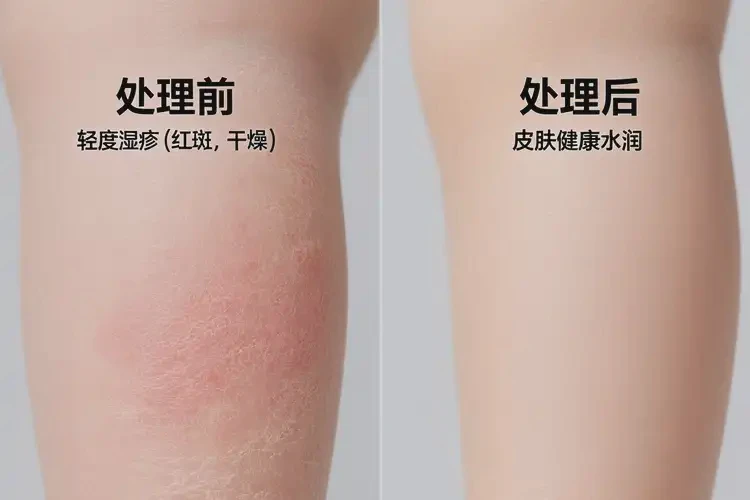 小孩小腿起濕疹不管它會自己痊愈嗎(圖3)