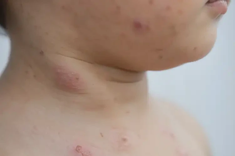 少兒脖子上偶爾起濕疹不管它會自己痊愈嗎(圖4)