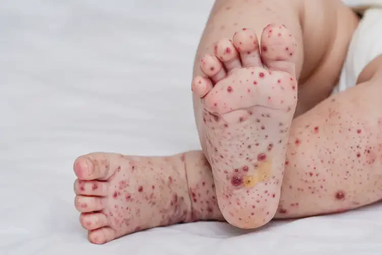 嬰幼兒小腿偶爾長濕疹可以徹底自愈嗎(圖2)