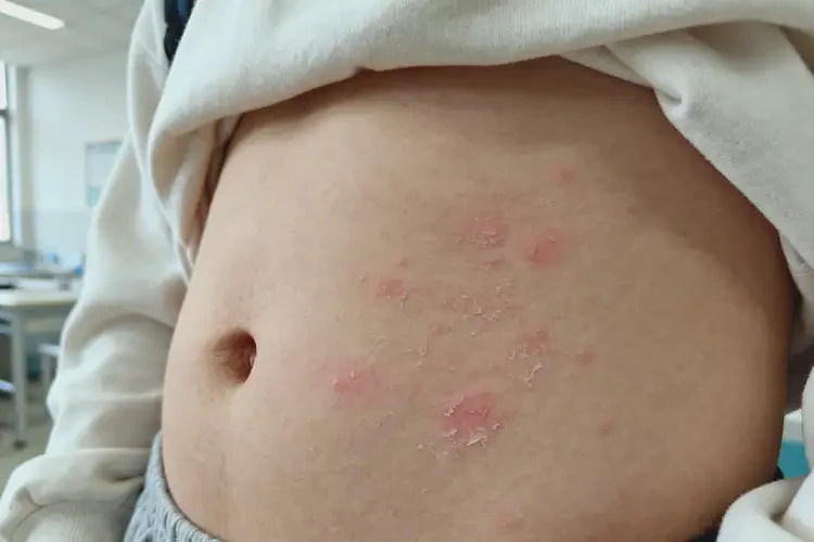 大學(xué)生肚子上起濕疹可以徹底自愈嗎(圖3)