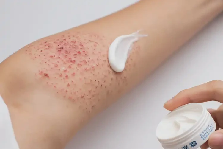 男人手臂上有濕疹不管它會(huì)自己自愈嗎(圖3)