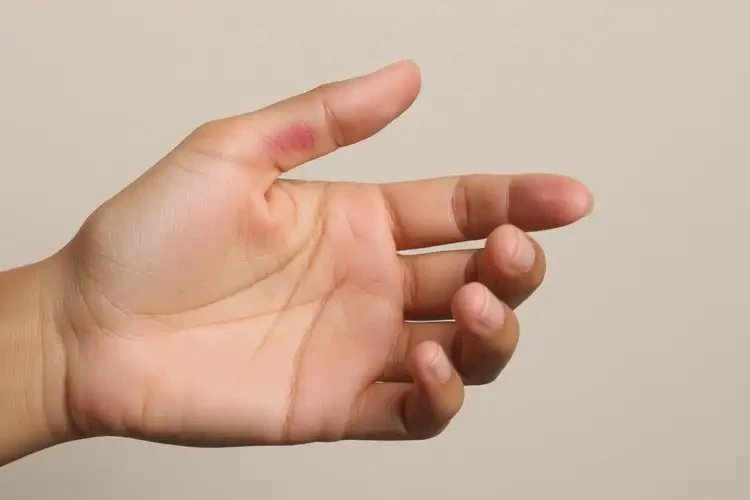 女性手上有濕疹能徹底自愈嗎(圖4)