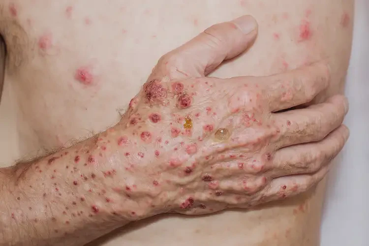 小学生手臂上出现湿疹能彻底自愈吗(图2)